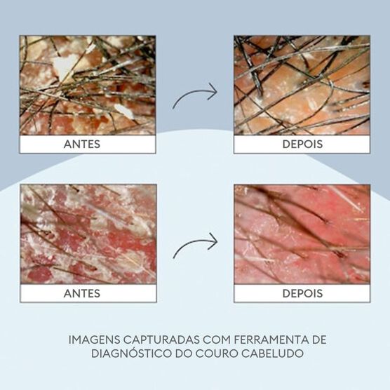 CHARCOAL+TEA TREE TRT 1OZ